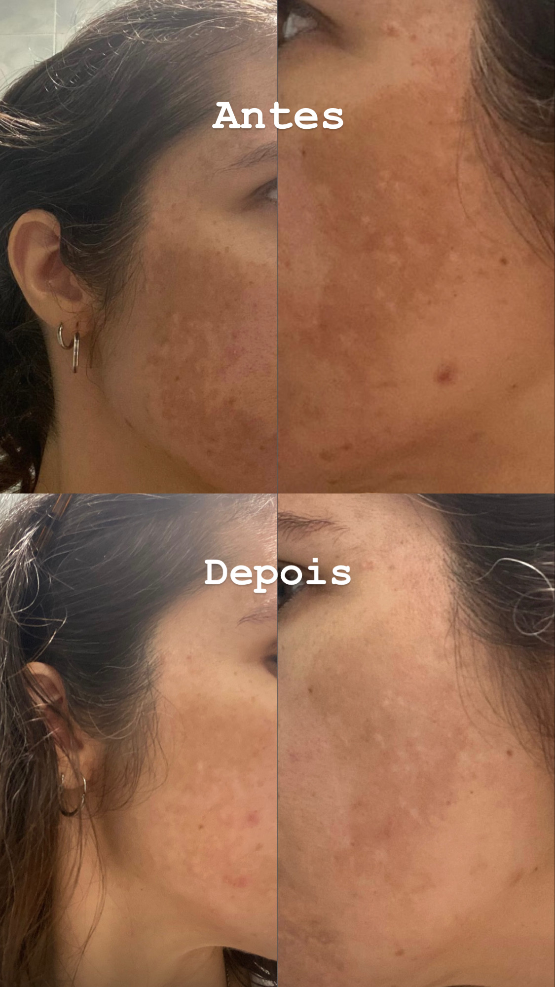 Antes e depois do cuidado com melasma